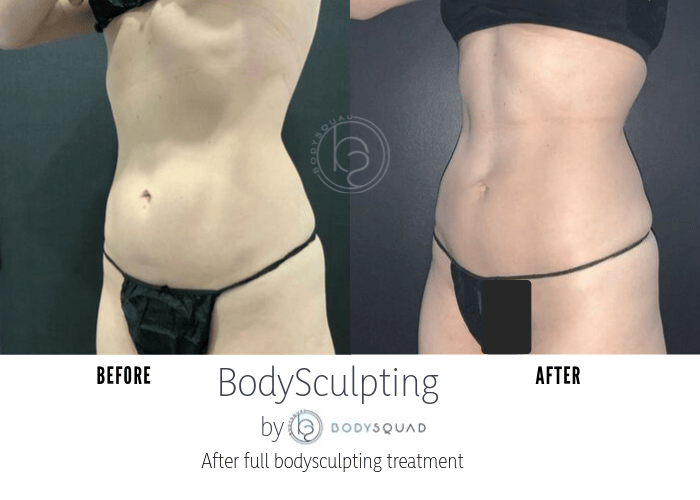 Bodysculpting at bodysquad before/after image of increased muscle definition with CoolSculpting and EmSculpt in Boca Raton