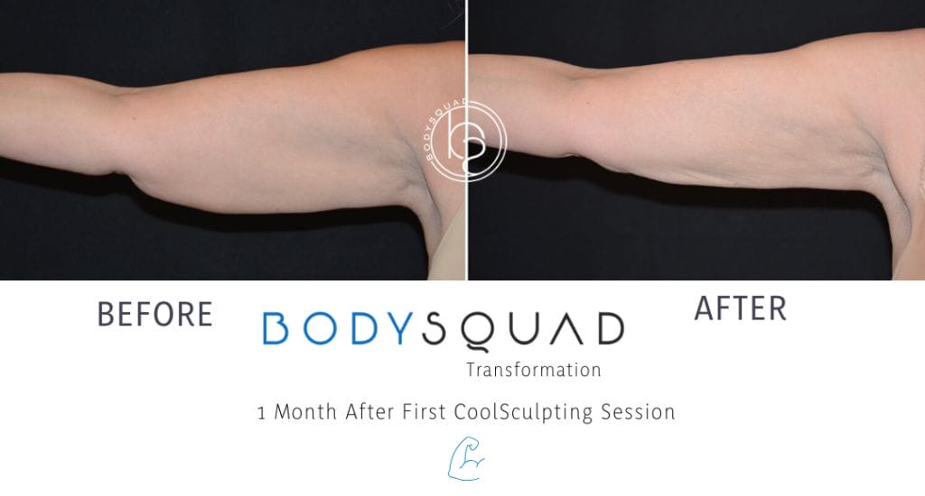 before and after BodySquad transformation photos of CoolSculpting treatments for sculpted arms in Boca Raton