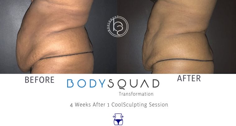 Before & After BodySquad transformation photo 50 year old women mid-section with CoolSculpting in South Florida