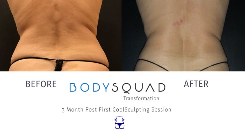 before and after photo of 55-year-old woman tightened up her mid-section with CoolSculpting at BodySquad Boca Raton