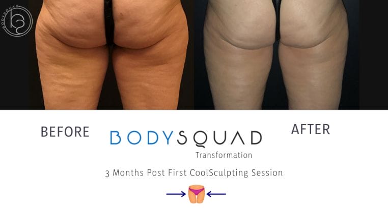 before and after photo of 58-year-old woman tighten up the skin and fat on her thighs with CoolSculpting at BodySquad Boca Raton