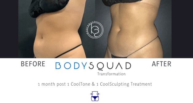 CoolSculpting and CoolTone bodysculpting transformation on the abdomen before and after photos from the BodySquad