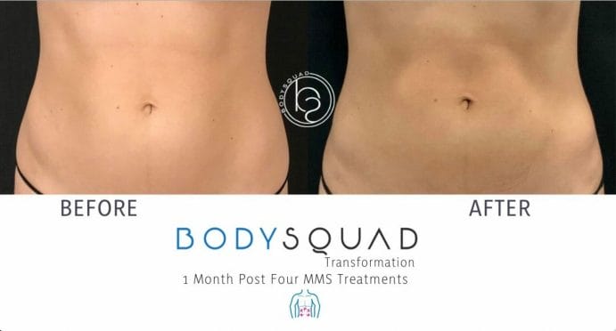 MMS bodysculpting before and after photos of postpartum body transformation at BodySquad Florida
