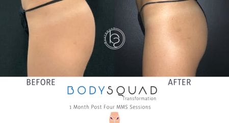 CoolTone Booty Transformations before and after at BodySquad south Florida