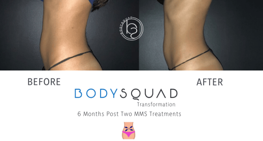 CoolTone abdomen treatment before/after at BodySquad South Florida