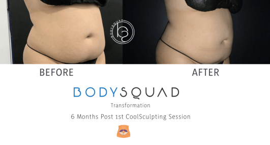 BodySculpting CoolSculpting before and after Results on the stomach at BodySquad 