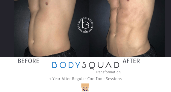CoolTone before and after side view results after 1 year of treatments at BodySquad Boca Raton