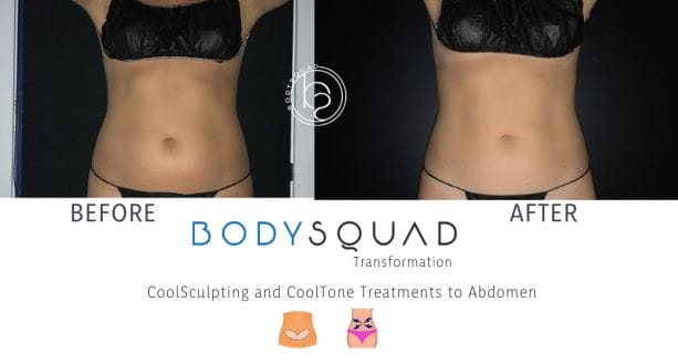 CoolSculpting and CoolTone on the abdomen front view before and after photos from the BodySquad