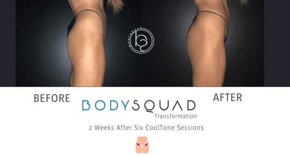 CoolTone before and after building booty transformation at BodySquad Boca Raton