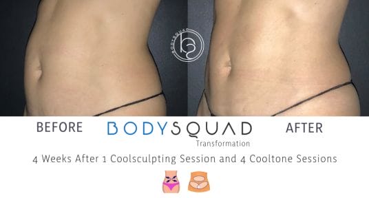 bodysculpting tummy transformation with CoolSculpting and CoolTone at BodySquad Boca Raton 
