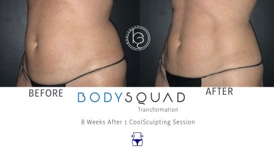 tummy toning with CoolSculpting at the BodySquad Boca Raton