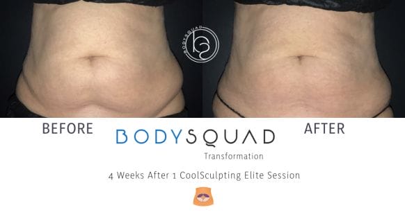 CoolSculpting and CoolTone non-invasive tummy tuck at BodySquad treating the mommy pooch