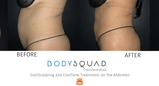 before and after maximizing results with CoolSculpting And CoolTone at BodySquad Boca Raton