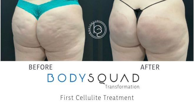 before and after results from innovative cellulite treatments at BodySquad south Florida