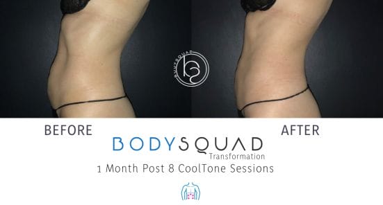 before and after photos from treating belly pooch with CoolTone for a bodysculpting at BodySquad