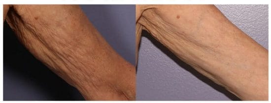 morpheus8 skin tightening treatment